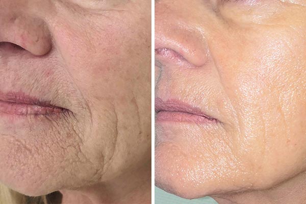 Hautstraffung mit DoubleTite