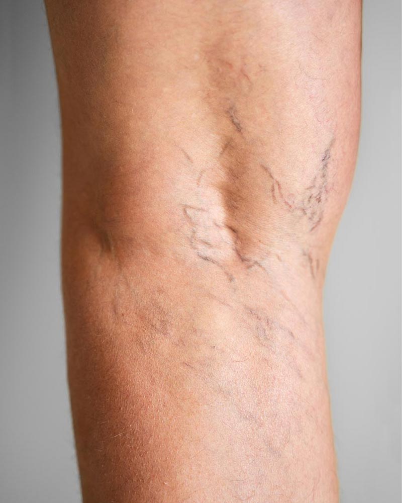 Besenreiser in der Kniekehle