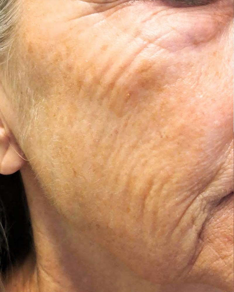 Wange vor der Hautstraffung