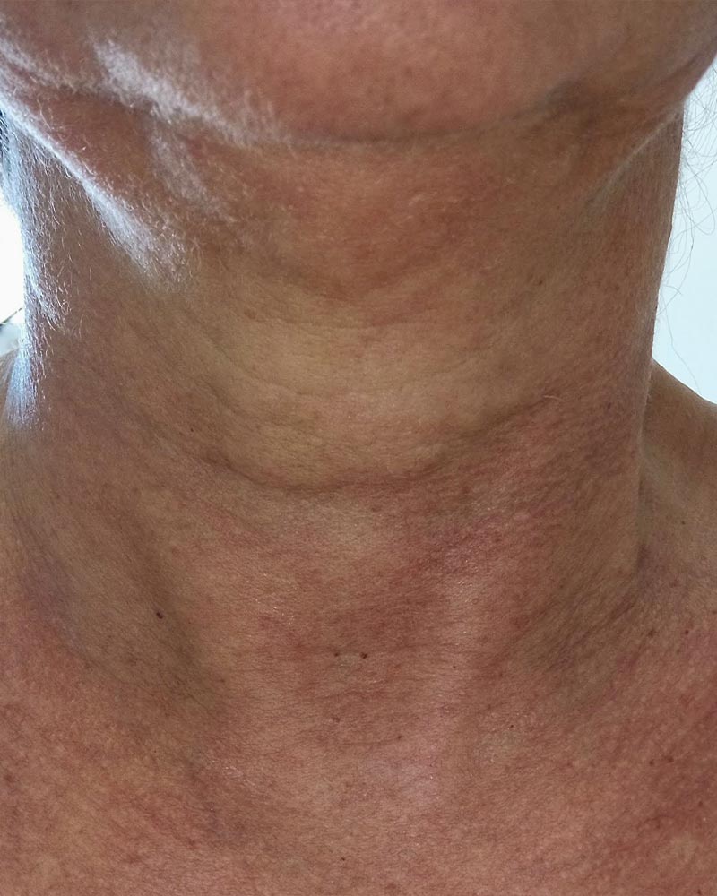 Hals vor der Hautstraffung